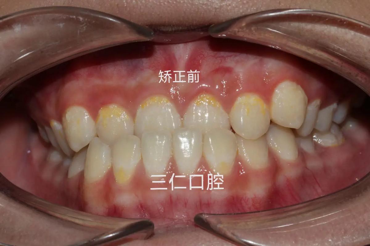 深圳种一颗牙矫正价格是多少 看完这篇心里有数