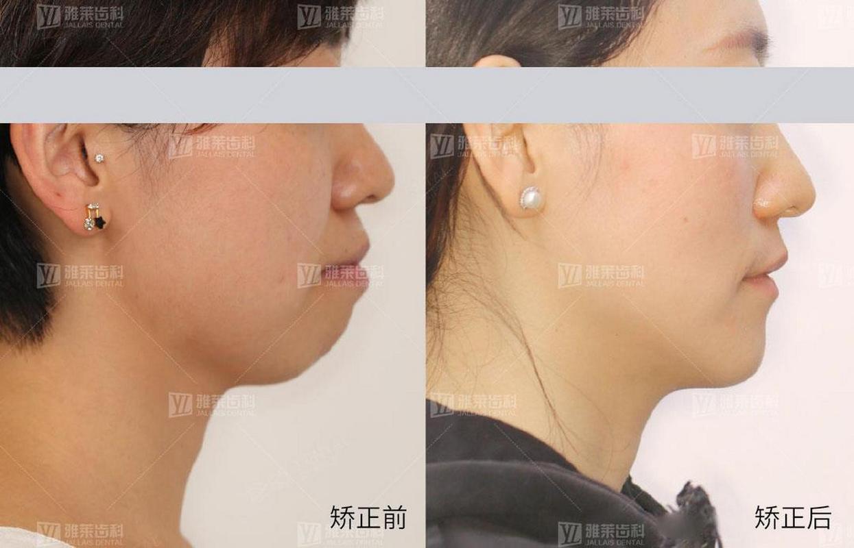 深圳矫正牙齿对脸型的改变到底有多大?真实对比告诉你