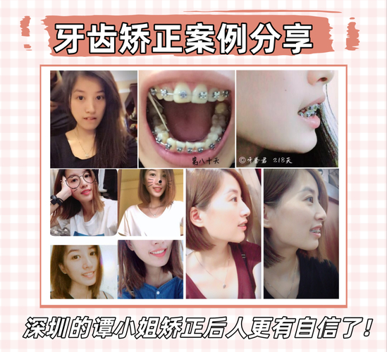 深圳福田成人地包天正畸医院怎么选?看完这篇不踩坑