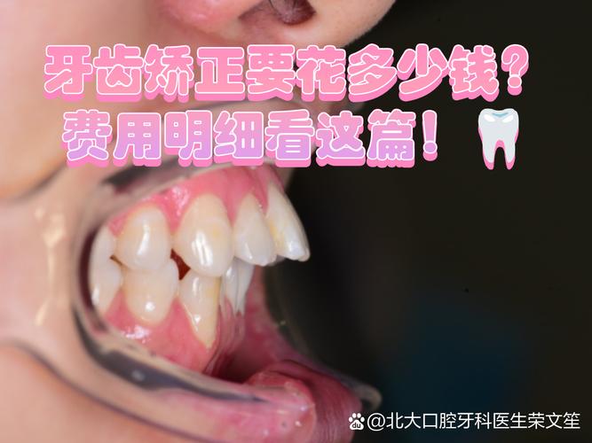 深圳广州牙齿矫正到底要花多少钱？看完这篇不踩坑