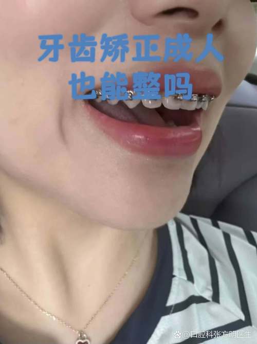 深圳成人地包天牙齿矫正 成年人还能做吗效果好吗