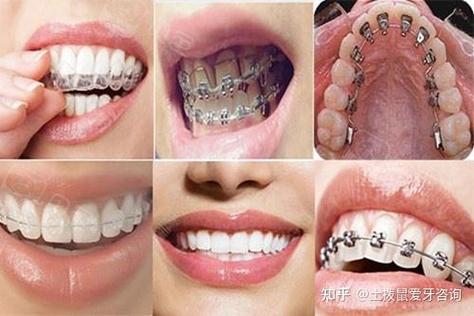 深圳34岁做牙齿矫正还来得及吗