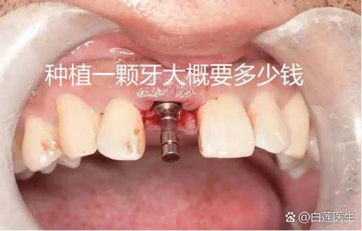深圳纯钛种牙多少钱一颗？费用明细和影响因素都在这里