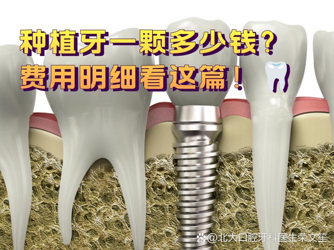 深圳2025年种牙一颗到底要花多少钱？看完这篇不踩坑