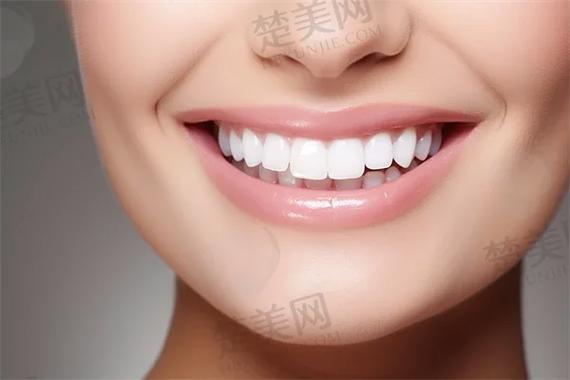 深圳杭州自锁牙齿矫正多少钱?真实费用全揭秘
