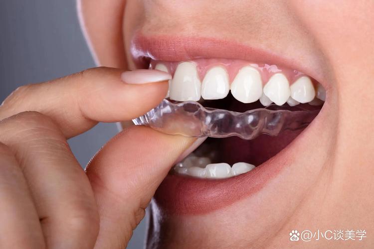 杭州矫正牙齿过程_牙齿矫正自锁多少钱_杭州自锁牙齿矫正