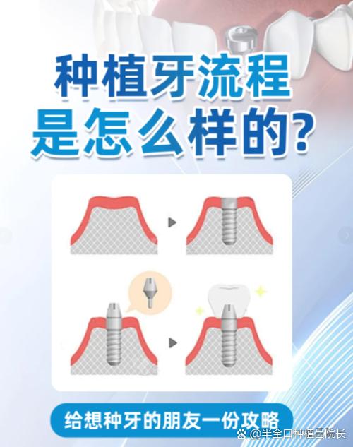 深圳上门牙种牙要多久 门牙种植美观又牢固