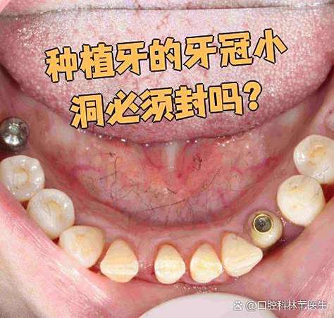 深圳龙华种牙价格_深圳龙华种植牙医院_深圳龙华全口种植牙当天装牙冠