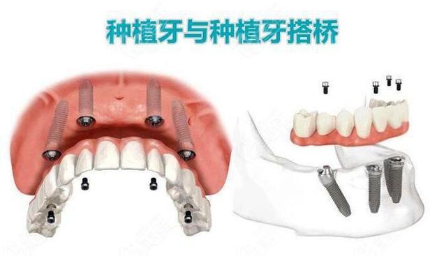 深圳种植牙还是搭桥哪个更好