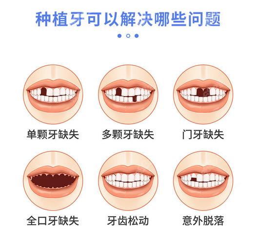 深圳宝安新安种植牙哪家医院好?靠谱选择看这几点