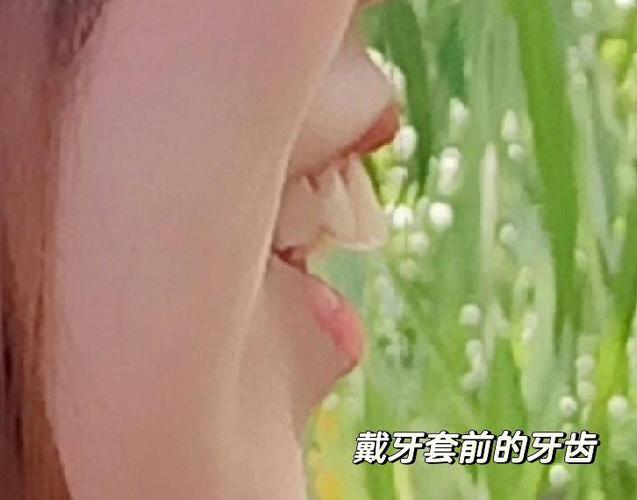 深圳骨性龅牙正畸选哪家医院？骨科正畸避坑全攻略