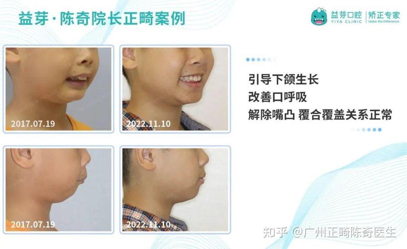 深圳东莞儿童牙齿矫正几岁开始最好？家长别等换完牙才后悔