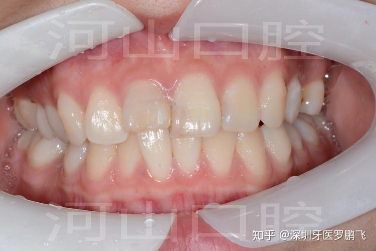 深圳20岁牙齿还能不能矫正?成年人正畸真实情况揭秘
