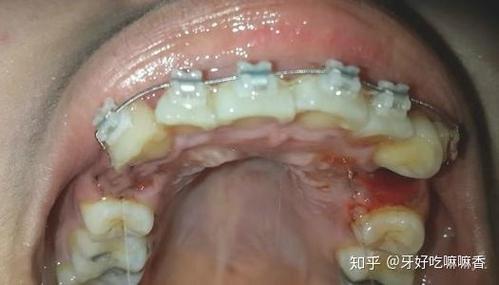 深圳宁波青少年牙齿矫正选哪家？费用多少？看完这篇就明白
