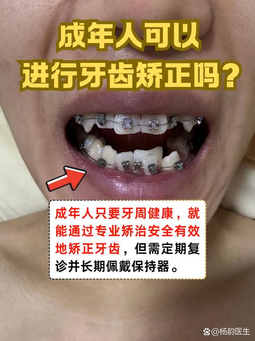 深圳30岁矫正牙齿还来得及吗 成年人正畸必看