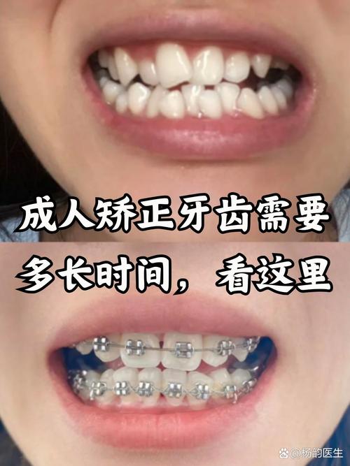 深圳35岁做牙齿矫正还来得及吗 真实效果和花费揭秘
