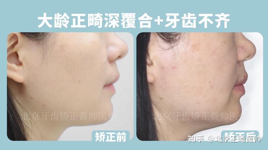 深圳45岁做深覆合矫正大概多少钱？费用明细全公开