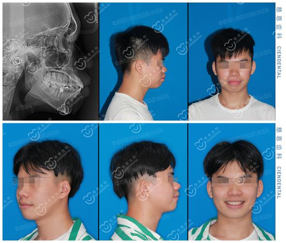 深圳罗湖骨性龅牙隐形矫正能行吗?方案详解