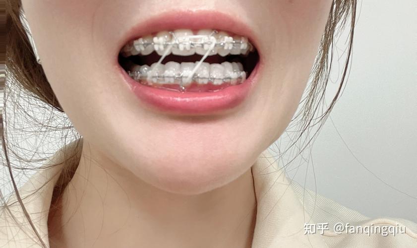 深圳27岁做牙齿矫正还来得及吗