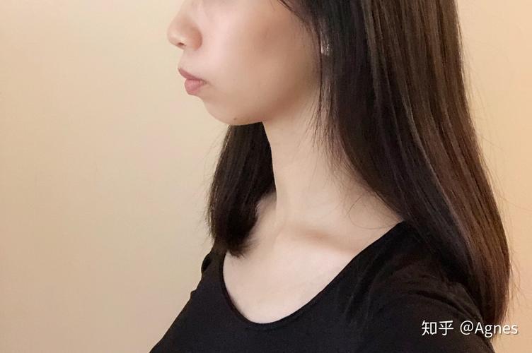 深圳龙岗隐适美矫正要多久?看完这篇就清楚了