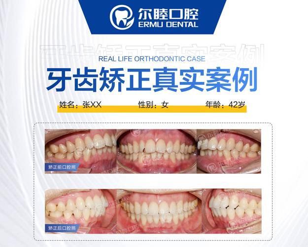 深圳牙缝过大矫正多少钱 2026最新报价参考