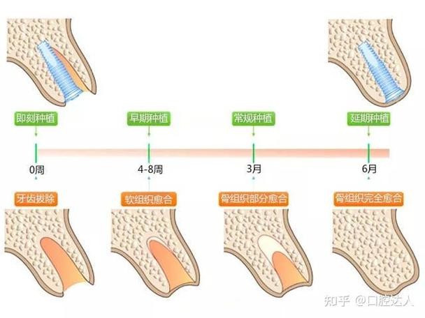 深圳掉3颗牙怎样种植？种牙流程全解析+费用避坑指南