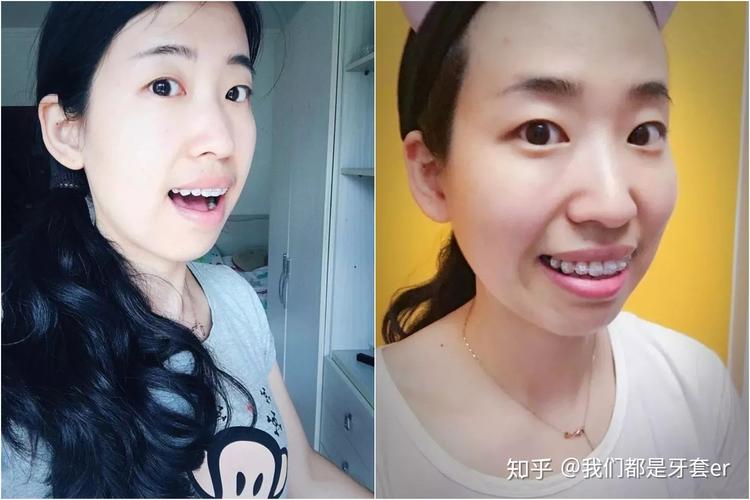 深圳30岁做牙齿矫正晚不晚？真实情况告诉你