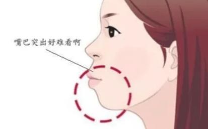 深圳正颌手术前必读：矫正牙齿正颌全过程详解