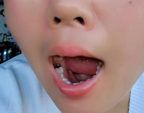 深圳55岁种牙好还是镶牙好？一文告诉你答案