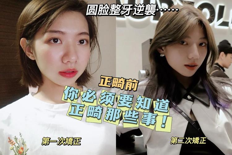 深圳23岁整牙还来得及吗？过来人说实话