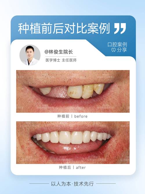 深圳罗湖东门种牙多少钱 2026最新价目表