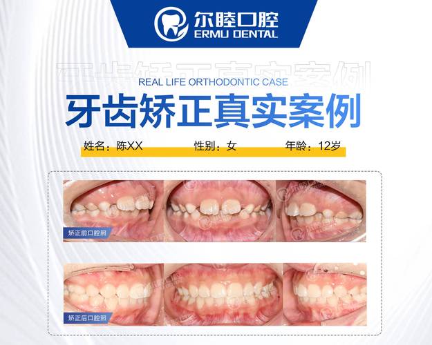 深圳西乡牙齿矫正费用到底要多少钱?2026年最新价格参考