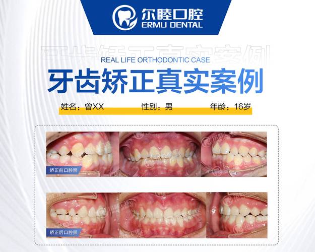 深圳福田青少年钢丝正畸费用_深圳福田青少年钢丝正畸费用_深圳福田青少年钢丝正畸费用