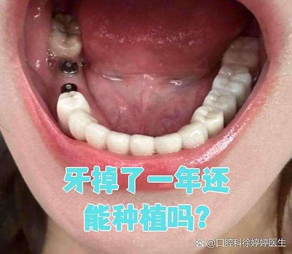 深圳牙齿掉了还能种吗？现在种牙靠谱不靠谱