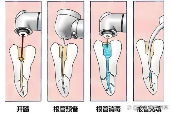 深圳种牙要等多久 最佳种牙时间全知道