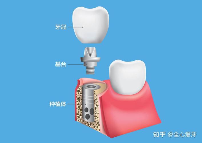 深圳佛山种植牙集采后4500元全包靠谱吗 2026最新解读