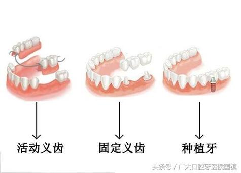 深圳儿童乳牙缺失别着急 种植牙修复方案全解