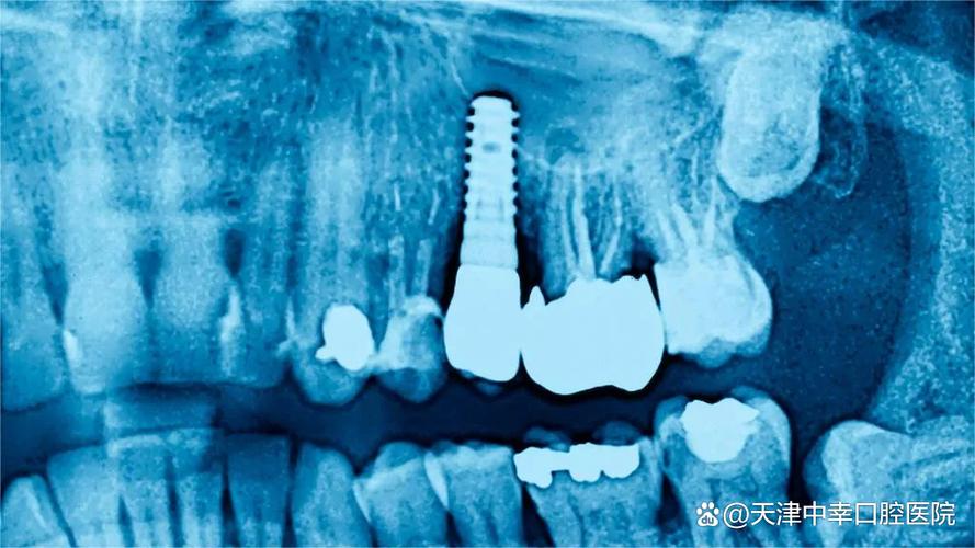 深圳罗湖骨量不足全口种牙到底要花多少钱