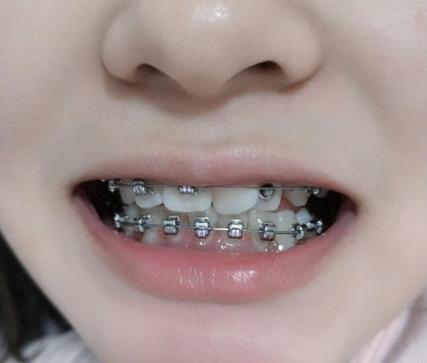 深圳30岁做牙齿矫正有什么后遗症？看完这篇不踩坑