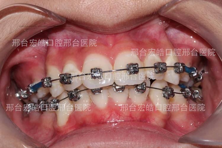 深圳不整齐牙齿矫正到底要花多少钱?大概多久能好?