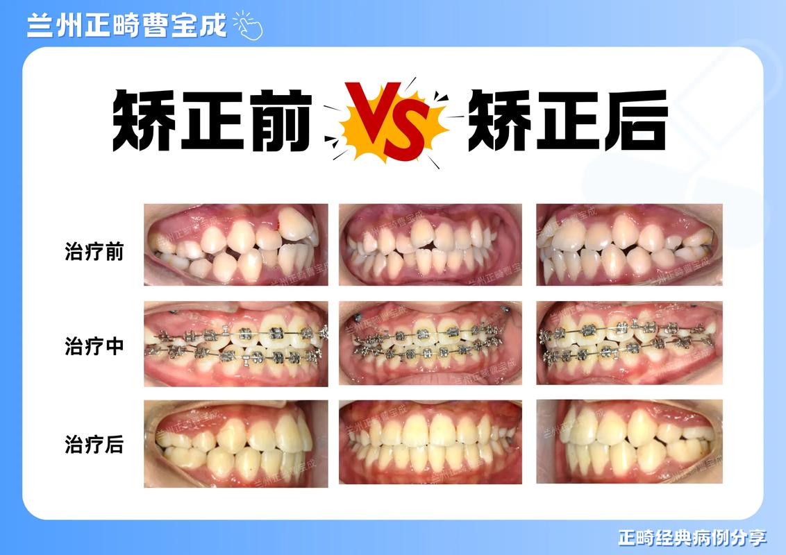 深圳35岁做牙齿正畸晚吗？成人矫正前先看这3点