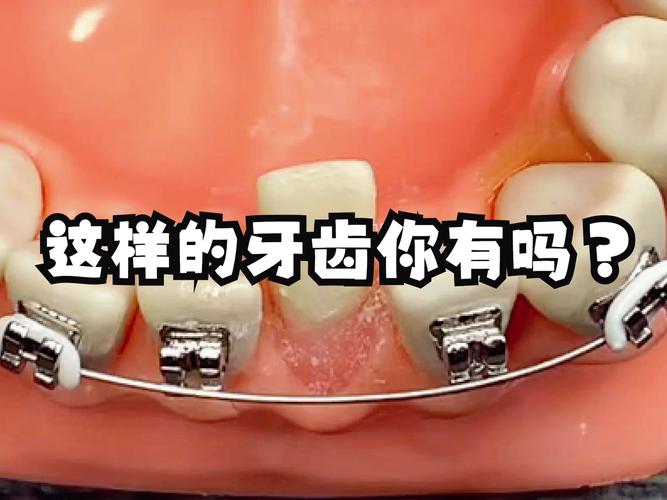 深圳8岁小孩牙齿歪了能矫正吗 家长别错过最佳时机