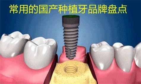 深圳潍坊国产种植牙百康特多少钱一颗？