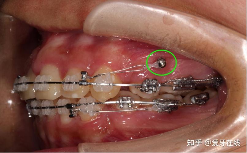 深圳20多岁矫正牙齿会后悔吗?医生说大实话