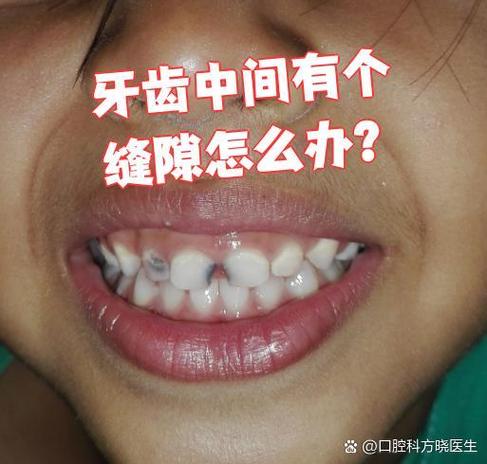 深圳门牙有缝怎么矫正?这几种方法亲测有效