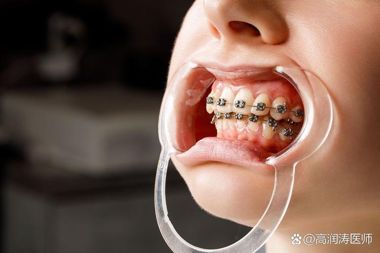 牙齿矫正能做一半吗_牙齿矫正能做ct吗_30多岁能做牙齿矫正吗