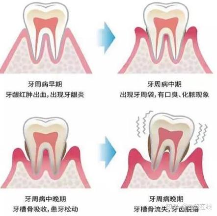 深圳三十岁还能整牙吗？成人牙齿矫正必知真相