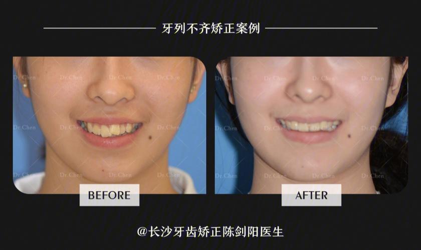 深圳拔门牙矫正牙齿会松动吗？正畸医生说出大实话