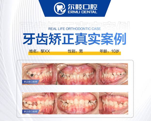 深圳隐形牙齿矫正价格_深圳隐适美矫正大概多少钱_深圳半隐形矫正医院地址