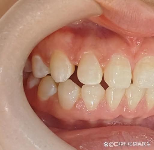 深圳牙缝过大矫正多少钱?最新价格一览